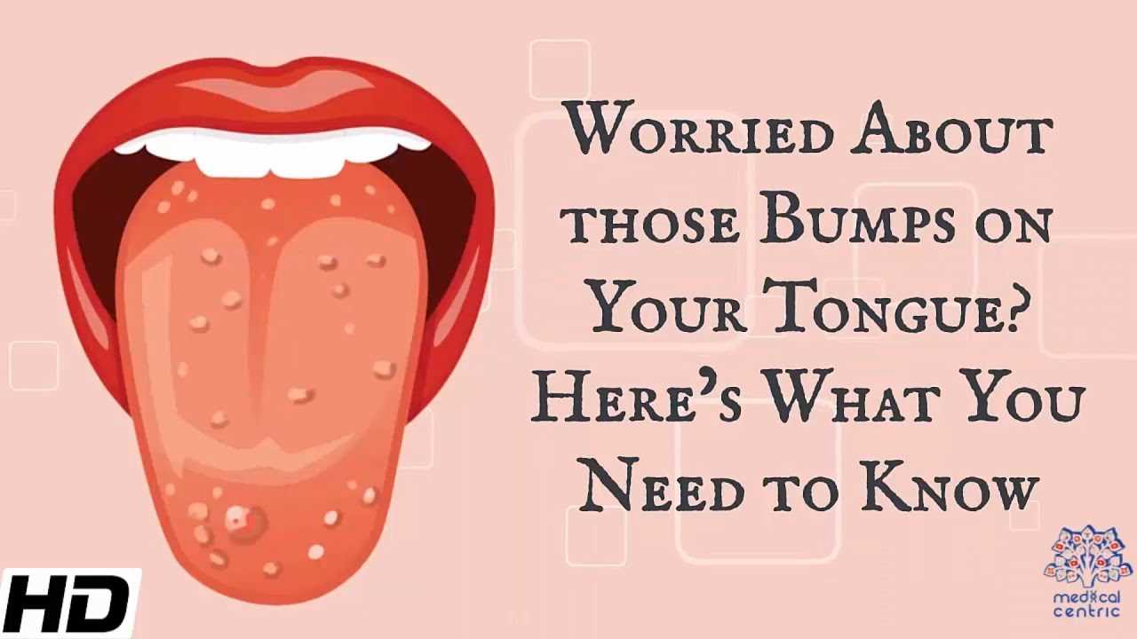 What Is Ball Tongue?