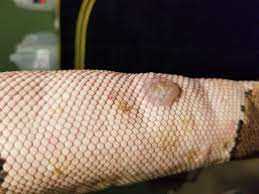 Blister disease in snakes