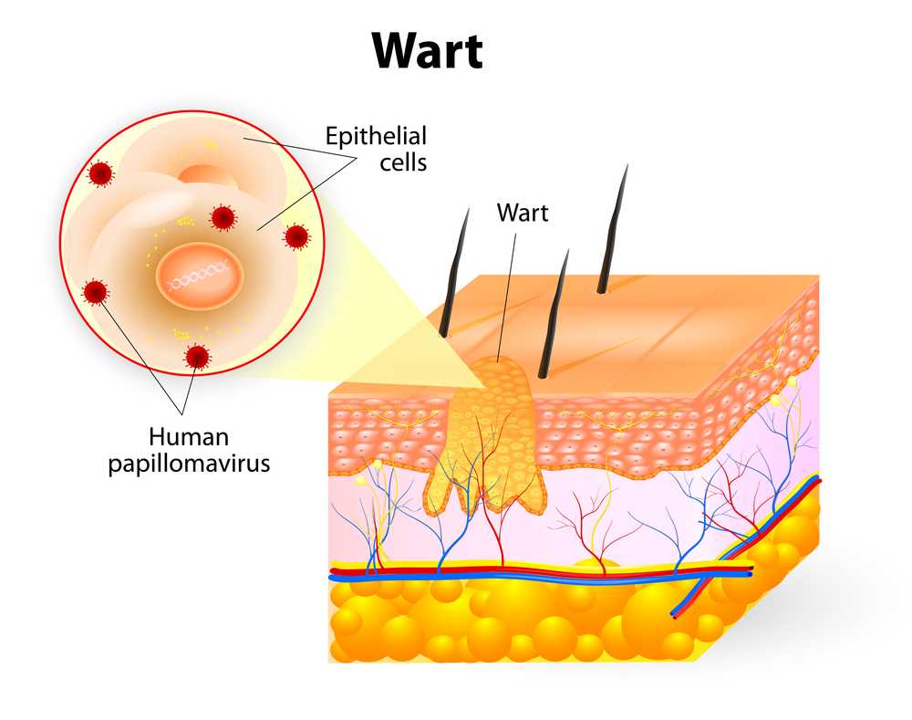 Can Frog Pee Cause Warts?